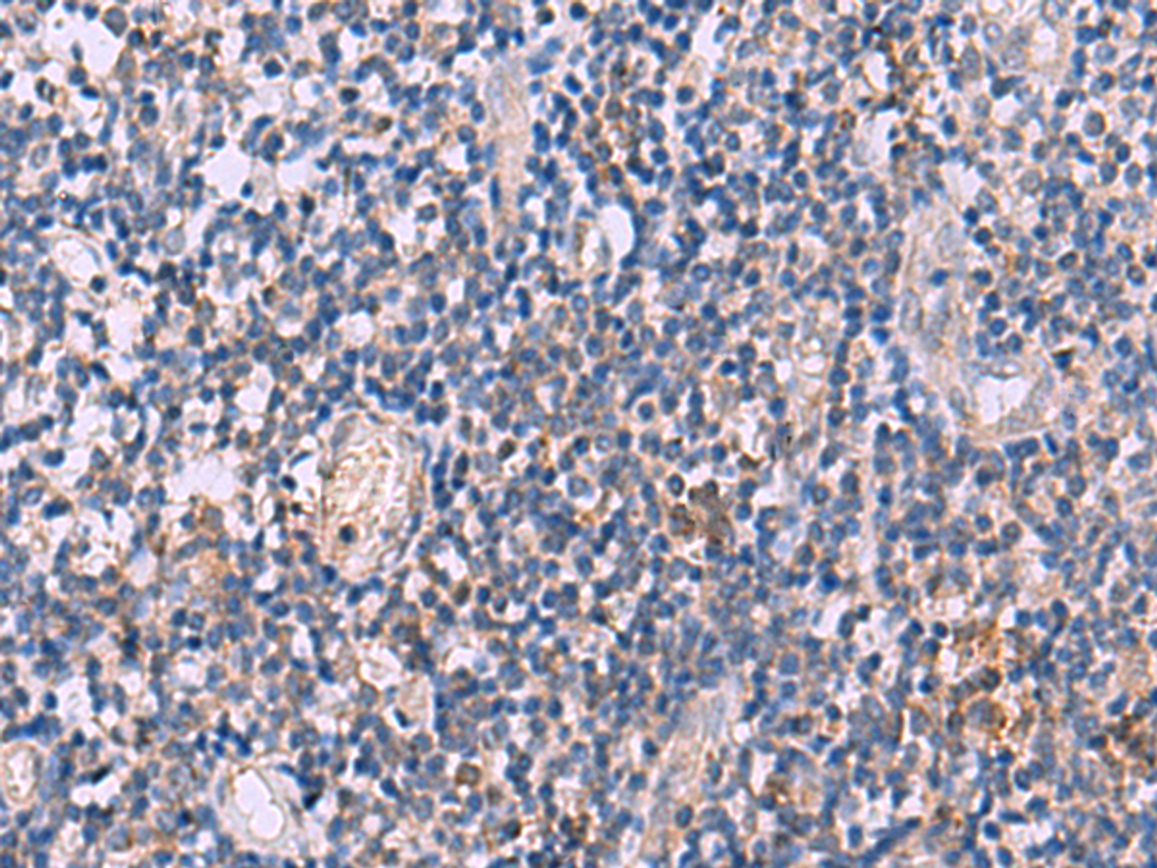 Immunohistochemistry of paraffin-embedded Human tonsil tissue  using IL4R Polyclonal Antibody at dilution of 1:45(×200)