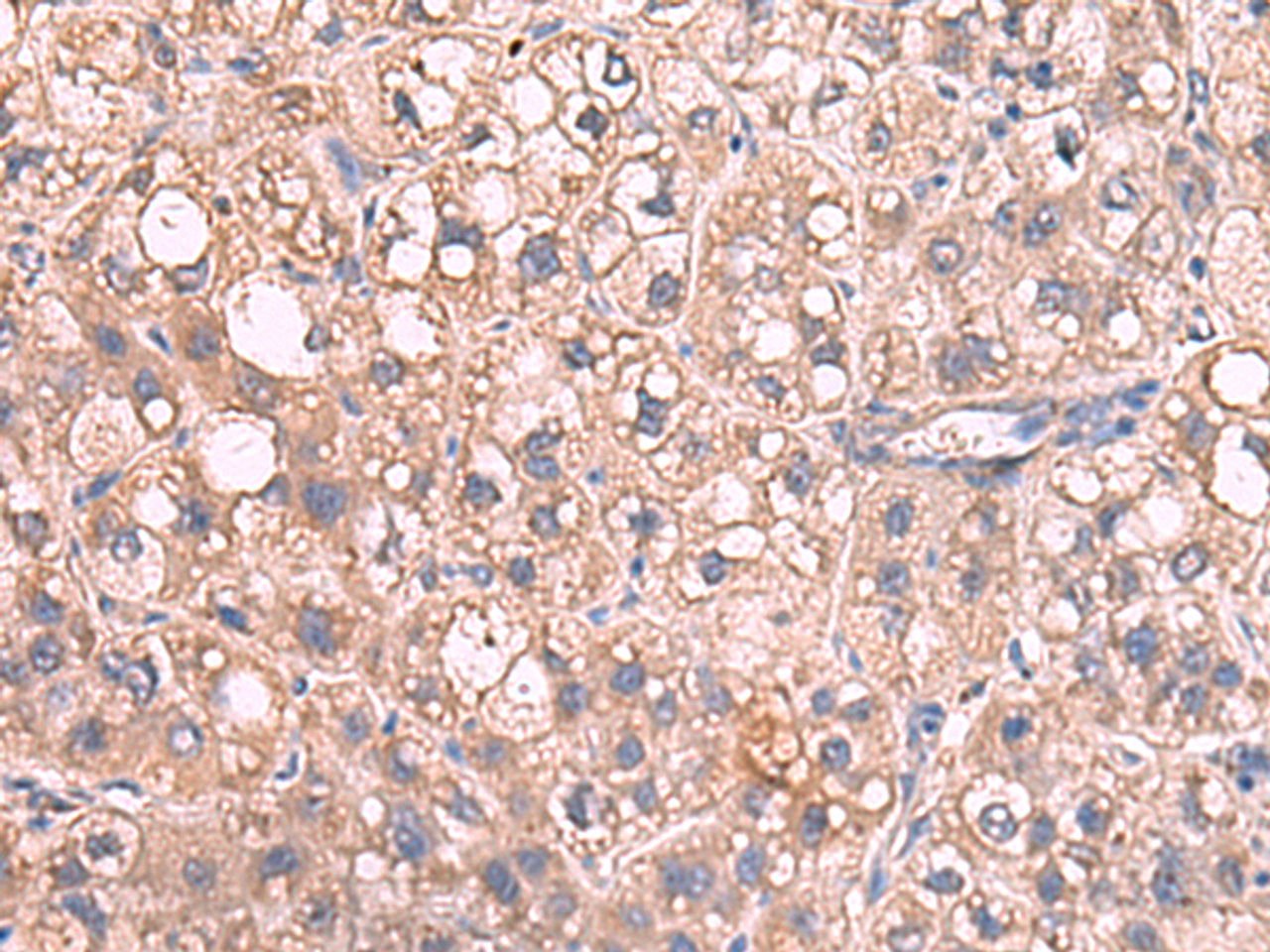 Immunohistochemistry of paraffin-embedded Human liver cancer tissue  using JAZF1 Polyclonal Antibody at dilution of 1:55(×200)