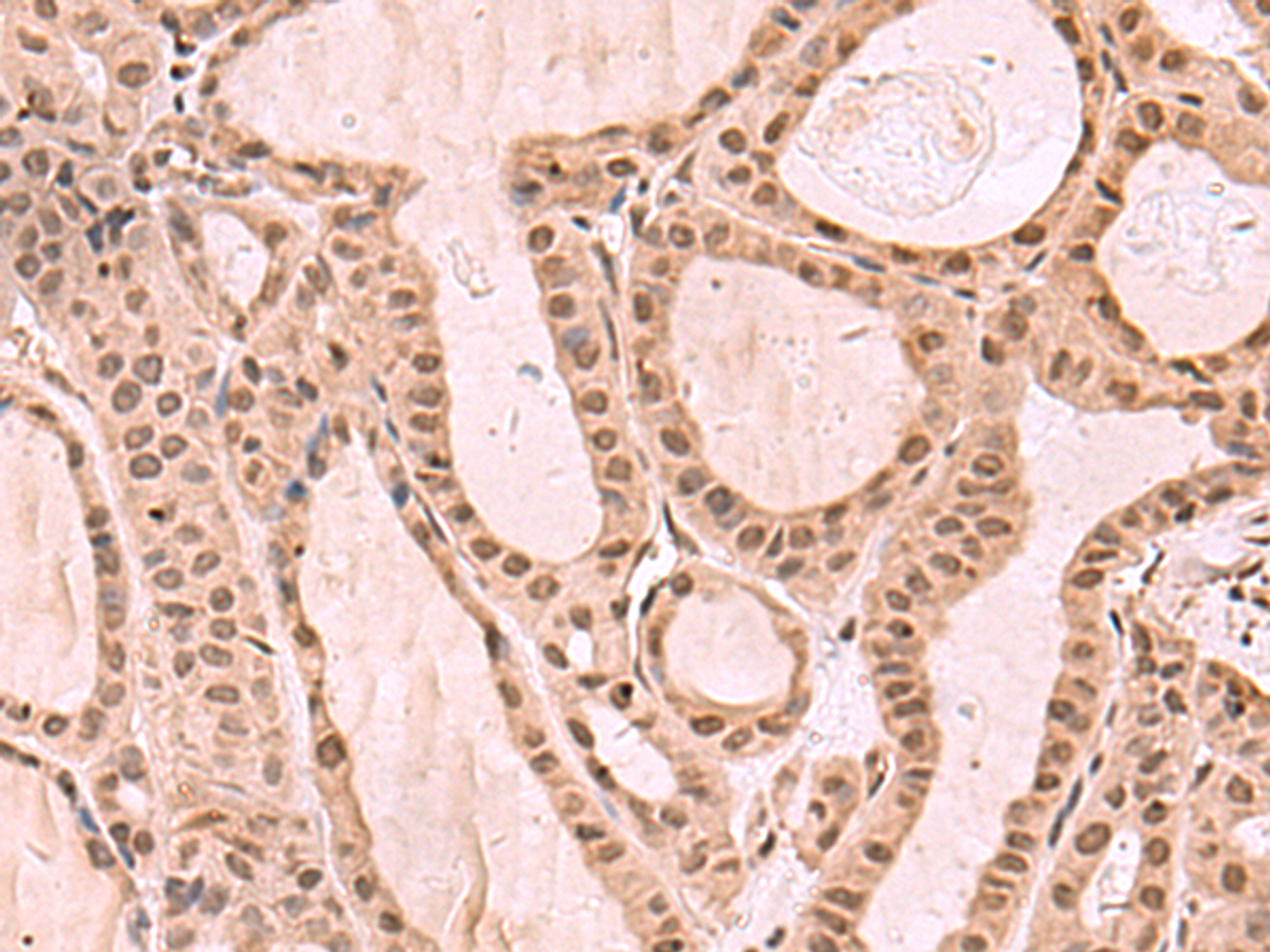 Immunohistochemistry of paraffin-embedded Human thyroid cancer tissue  using KDM7A Polyclonal Antibody at dilution of 1:35(×200)