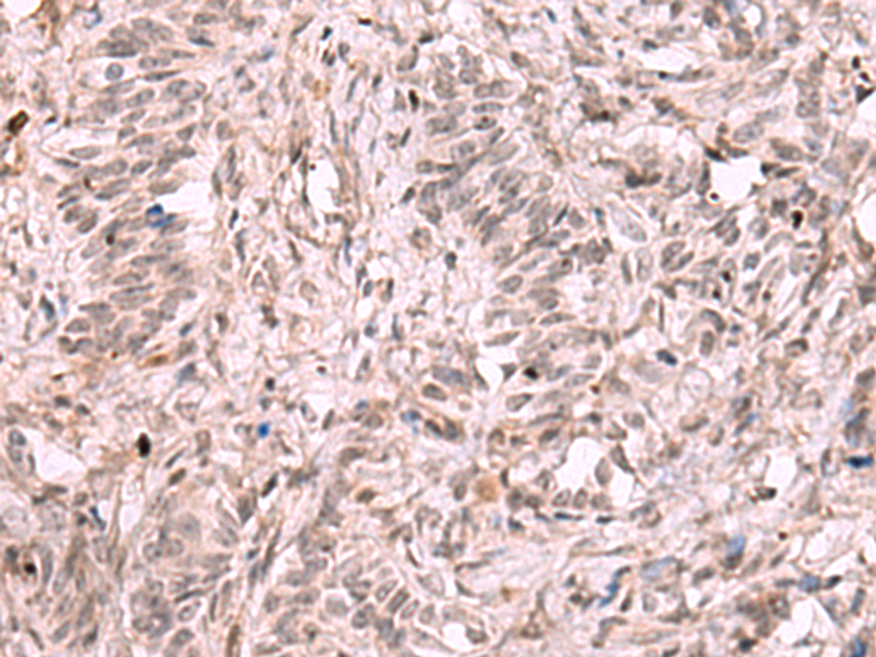 Immunohistochemistry of paraffin-embedded Human ovarian cancer tissue  using KDM7A Polyclonal Antibody at dilution of 1:35(×200)