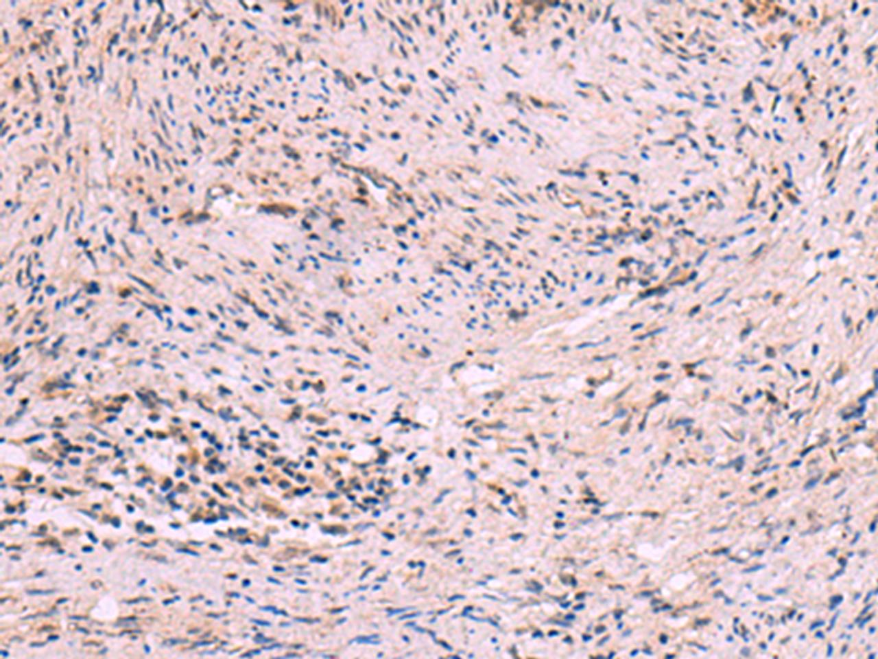 Immunohistochemistry of paraffin-embedded Human cervical cancer tissue  using MBTPS2 Polyclonal Antibody at dilution of 1:30(×200)