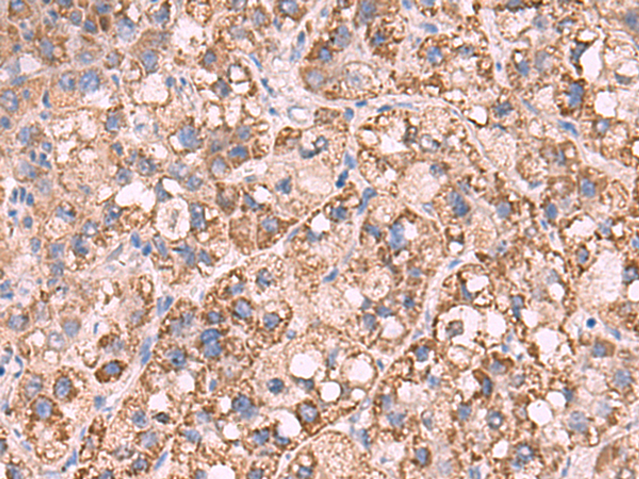 Immunohistochemistry of paraffin-embedded Human liver cancer tissue  using KCNN1 Polyclonal Antibody at dilution of 1:55(×200)