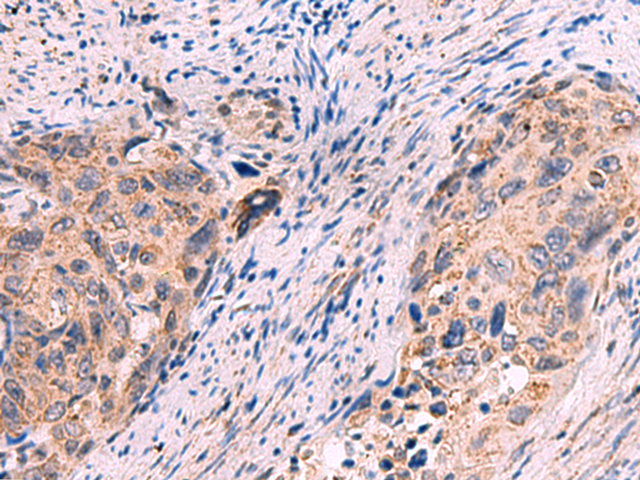 Immunohistochemistry of paraffin-embedded Human cervical cancer tissue  using KCNN1 Polyclonal Antibody at dilution of 1:55(×200)