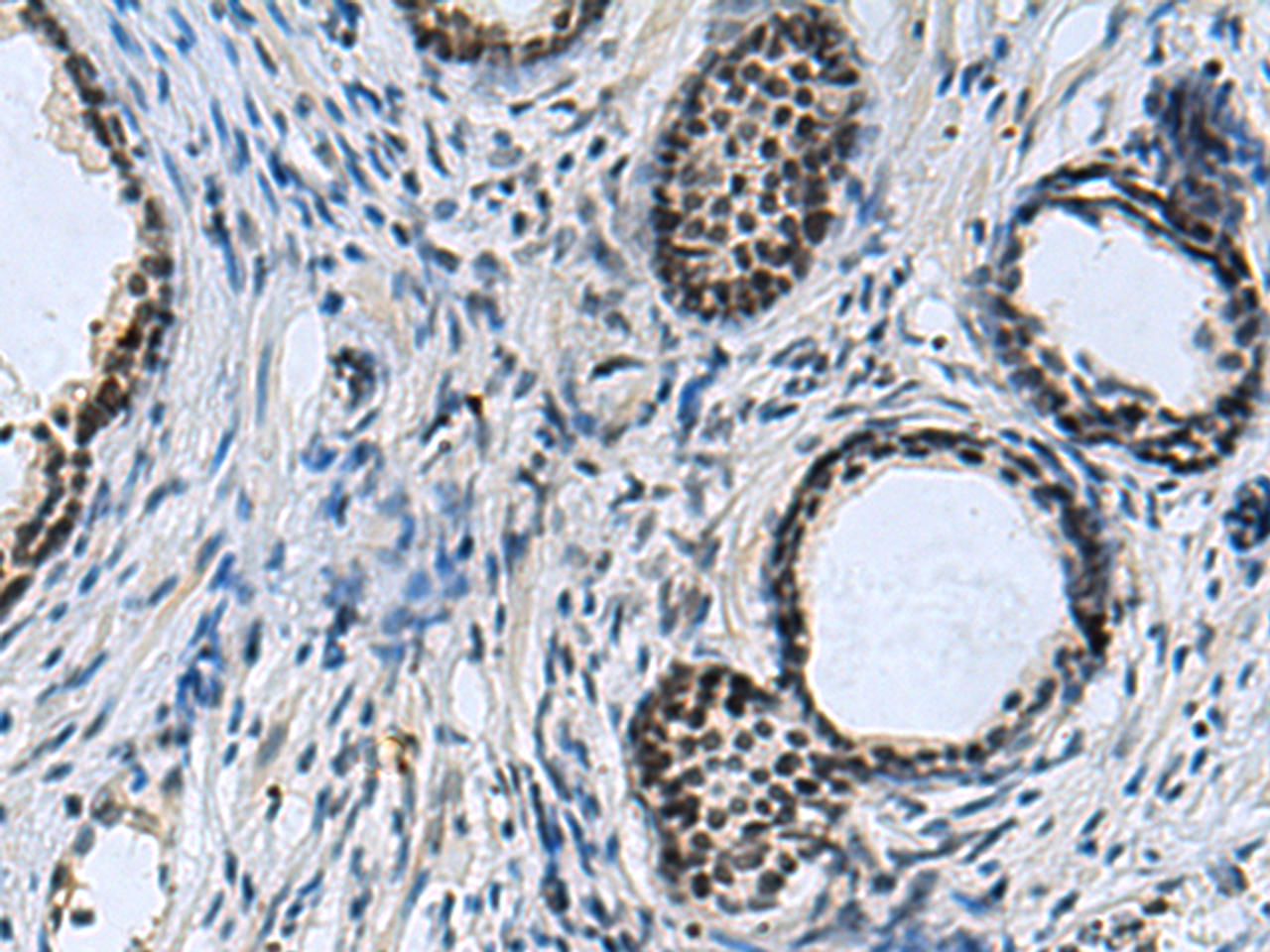 Immunohistochemistry of paraffin-embedded Human prost at e cancer tissue  using CCAR2 Polyclonal Antibody at dilution of 1:40(×200)