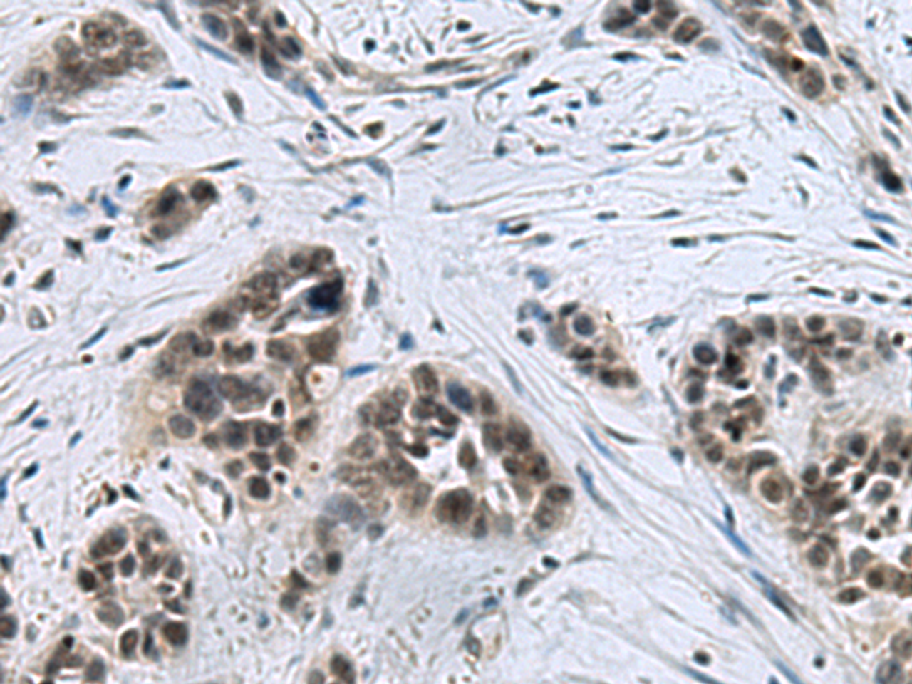 Immunohistochemistry of paraffin-embedded Human thyroid cancer tissue  using CCAR2 Polyclonal Antibody at dilution of 1:40(×200)