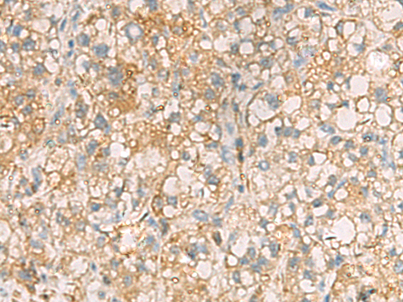Immunohistochemistry of paraffin-embedded Human liver cancer tissue  using ANXA13 Polyclonal Antibody at dilution of 1:105(×200)