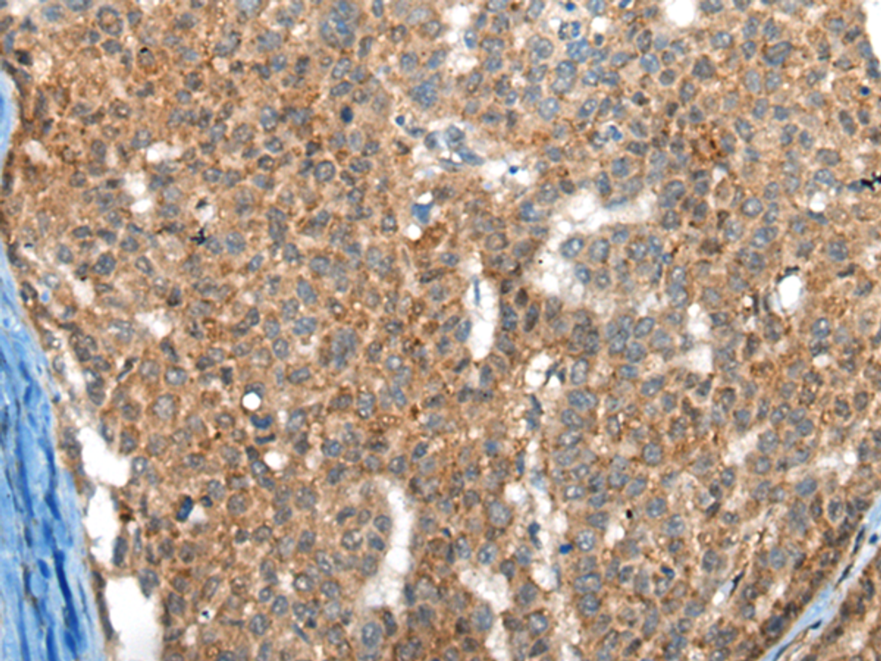 Immunohistochemistry of paraffin-embedded Human liver cancer tissue  using FTL Polyclonal Antibody at dilution of 1:30(×200)