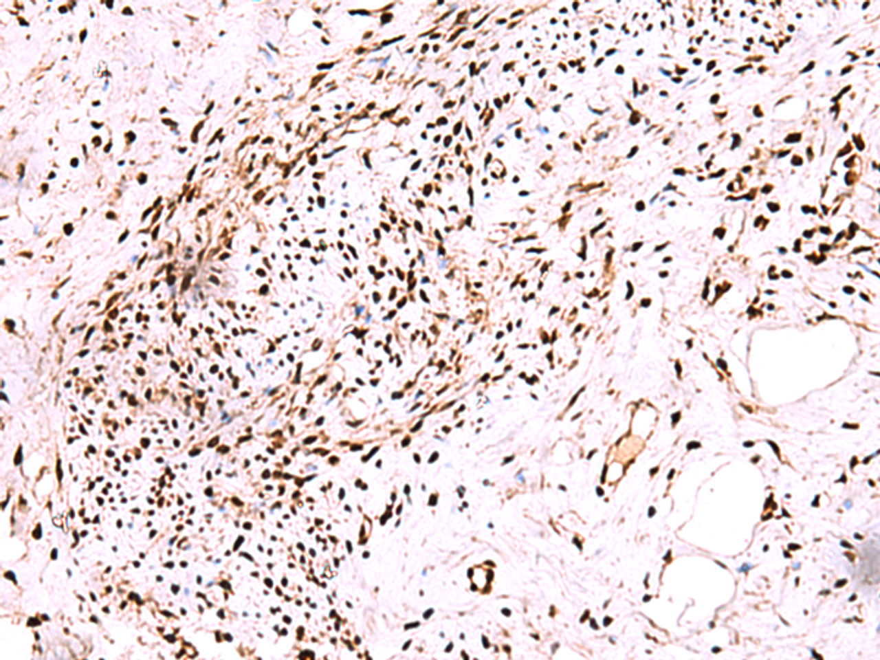 Immunohistochemistry of paraffin-embedded Human cervical cancer tissue  using CDKN1B Polyclonal Antibody at dilution of 1:75(×200)