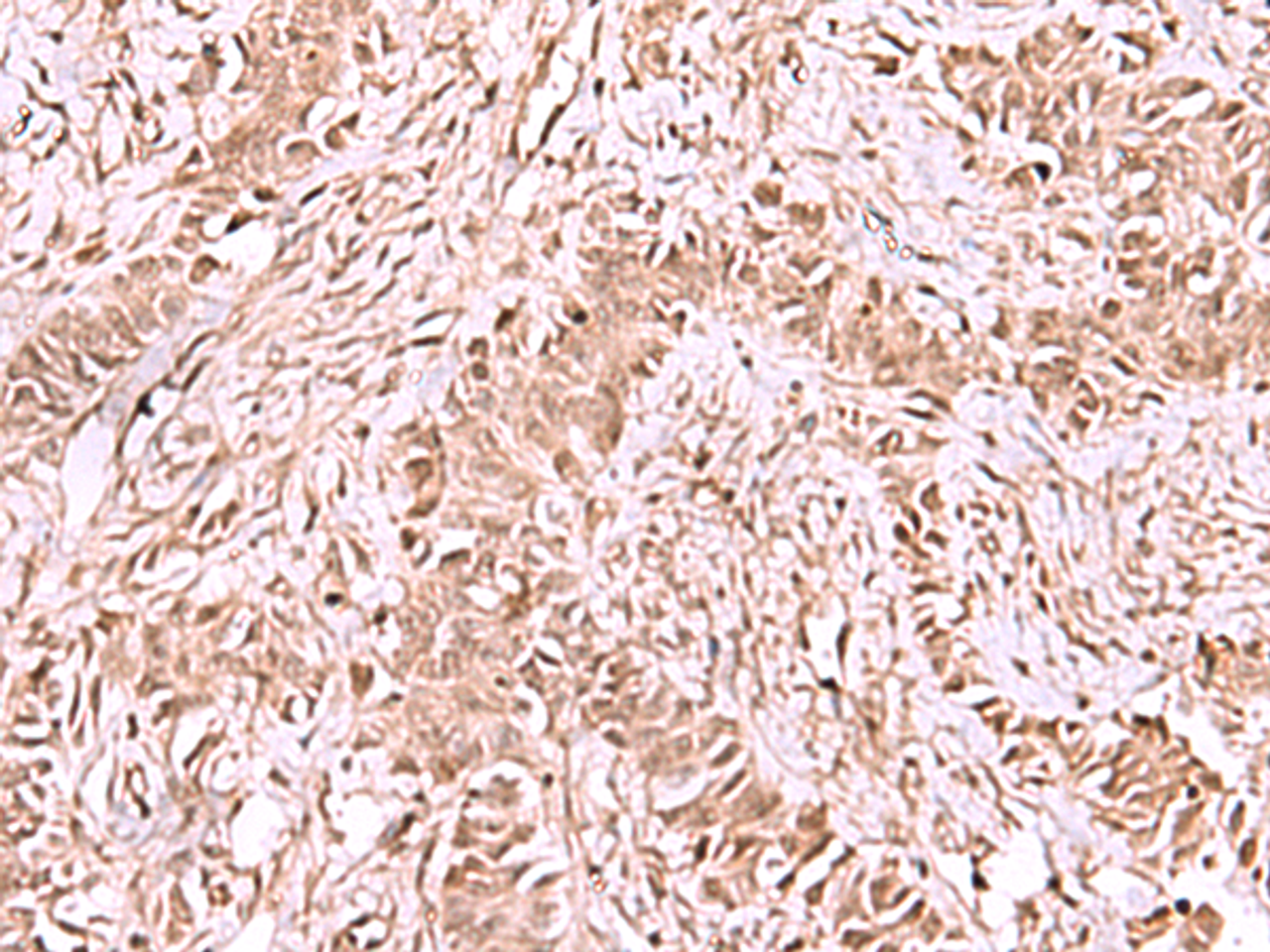 Immunohistochemistry of paraffin-embedded Human ovarian cancer tissue  using CDKN1B Polyclonal Antibody at dilution of 1:75(×200)