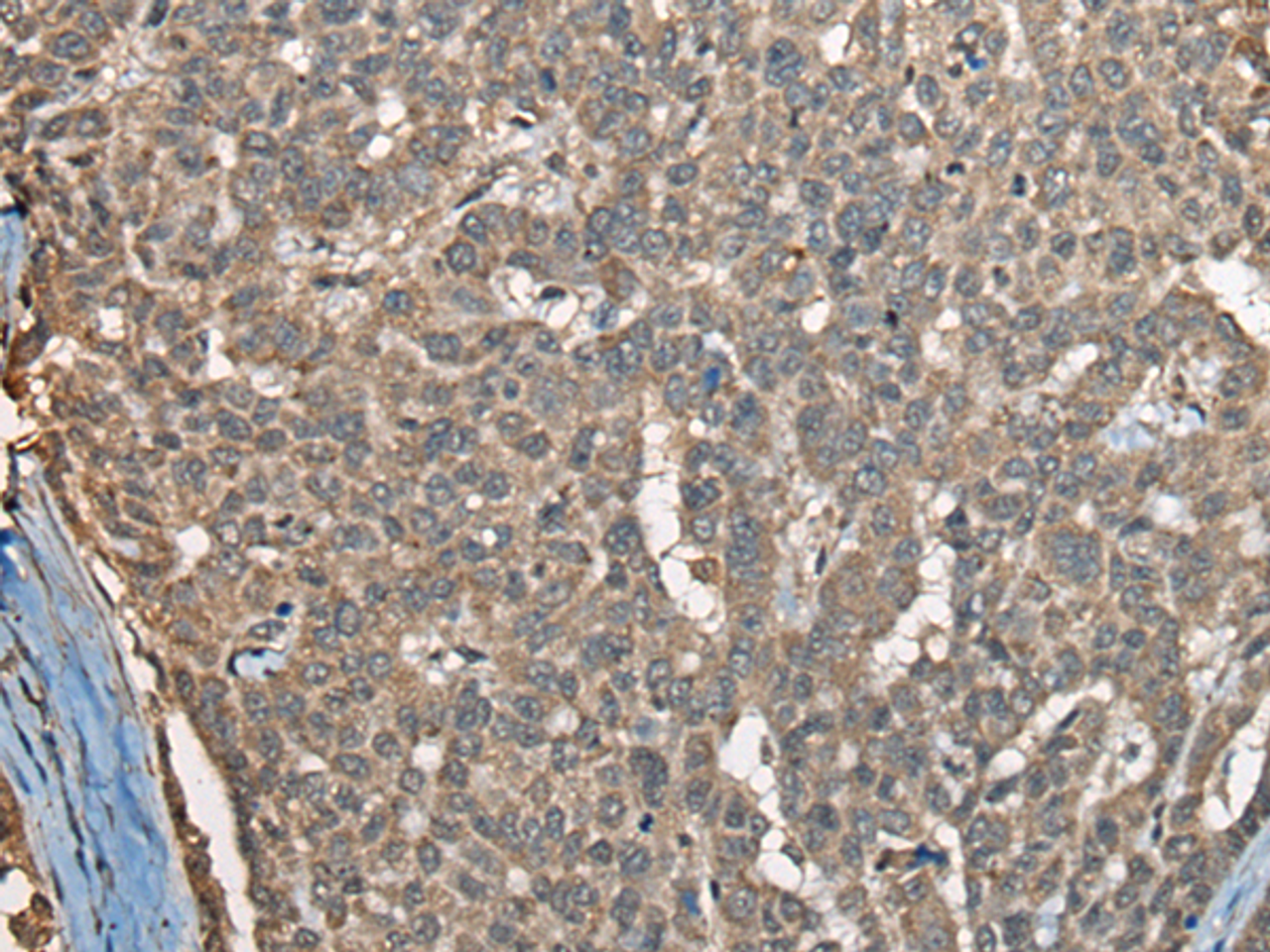 Immunohistochemistry of paraffin-embedded Human liver cancer tissue  using COX7A2L Polyclonal Antibody at dilution of 1:30(×200)
