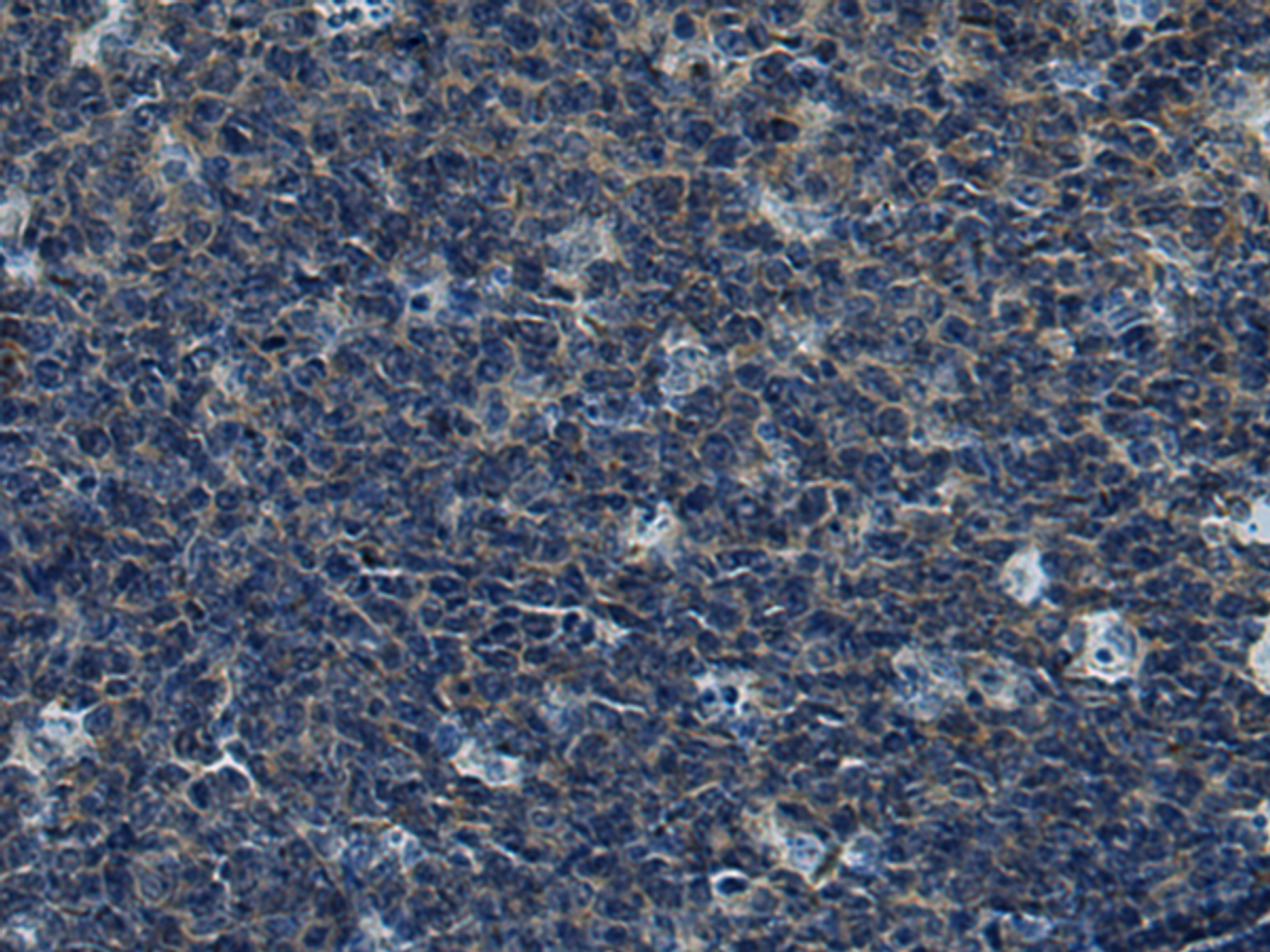 Immunohistochemistry of paraffin-embedded Human tonsil tissue  using CUL5 Polyclonal Antibody at dilution of 1:55(×200)