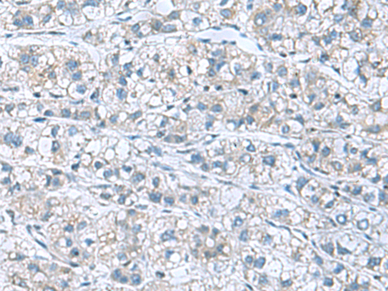 Immunohistochemistry of paraffin-embedded Human liver cancer tissue  using GDF9 Polyclonal Antibody at dilution of 1:55(×200)