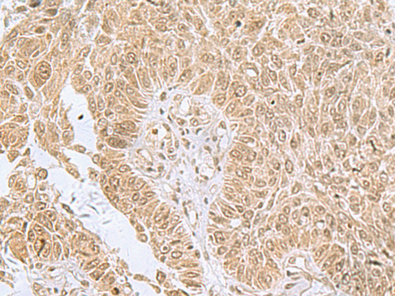 Immunohistochemistry of paraffin-embedded Human lung cancer tissue  using PHF6 Polyclonal Antibody at dilution of 1:85(×200)