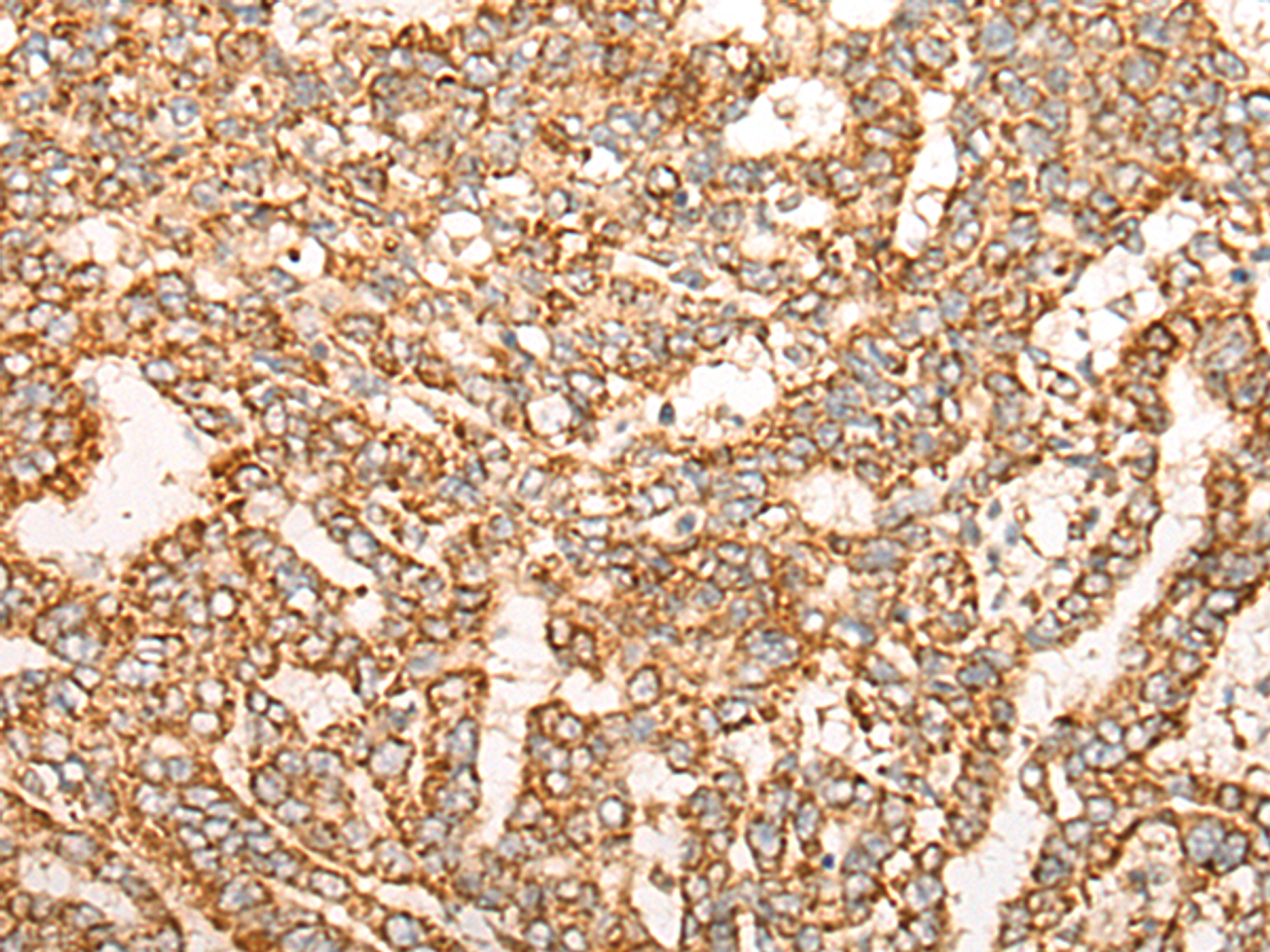 Immunohistochemistry of paraffin-embedded Human liver cancer tissue  using NR0B2 Polyclonal Antibody at dilution of 1:35(×200)