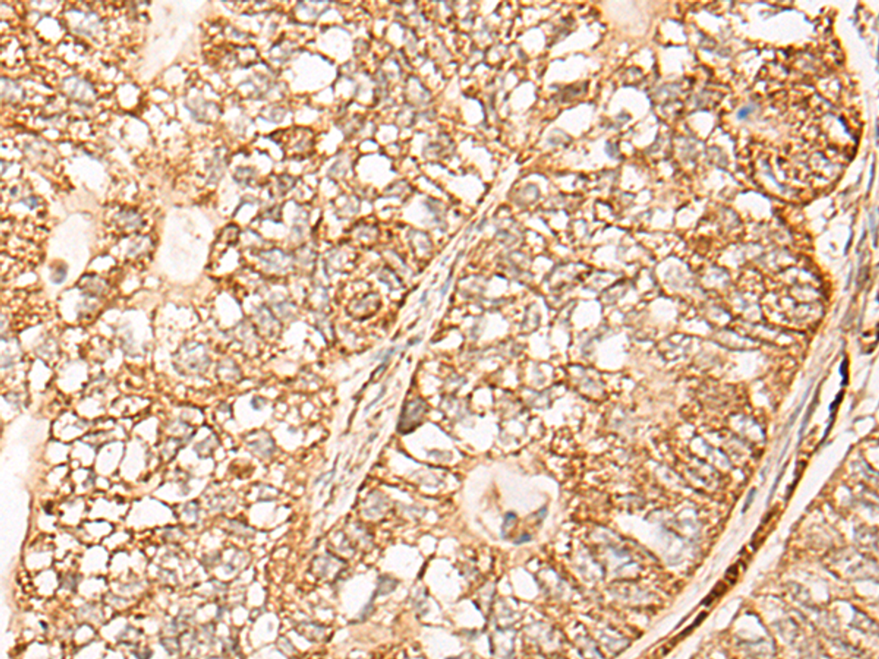 Immunohistochemistry of paraffin-embedded Human gastric cancer tissue  using NR0B2 Polyclonal Antibody at dilution of 1:35(×200)