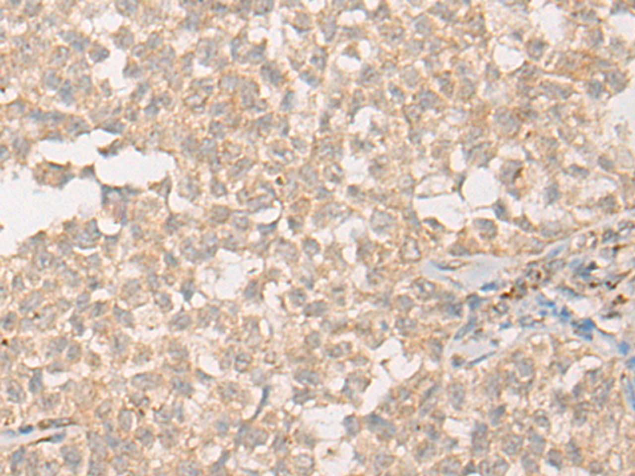 Immunohistochemistry of paraffin-embedded Human ovarian cancer tissue  using PPM1D Polyclonal Antibody at dilution of 1:60(×200)