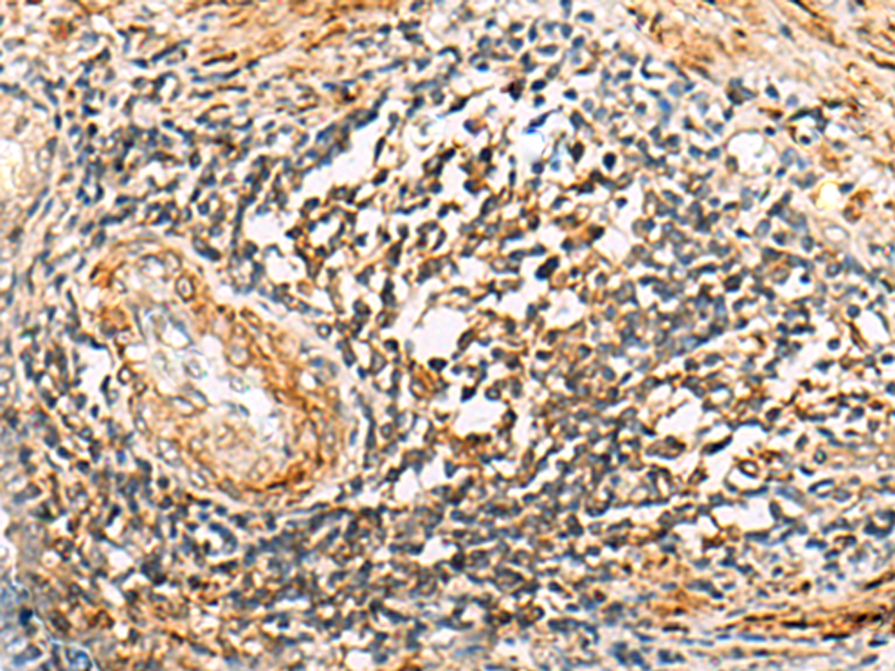 Immunohistochemistry of paraffin-embedded Human prost ate cancer tissue  using NLRC4 Polyclonal Antibody at dilution of 1:50(×200)