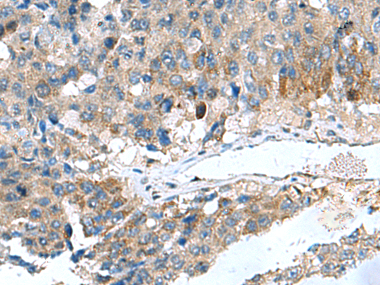 Immunohistochemistry of paraffin-embedded Human liver cancer tissue  using HSD11B1 Polyclonal Antibody at dilution of 1:70(×200)