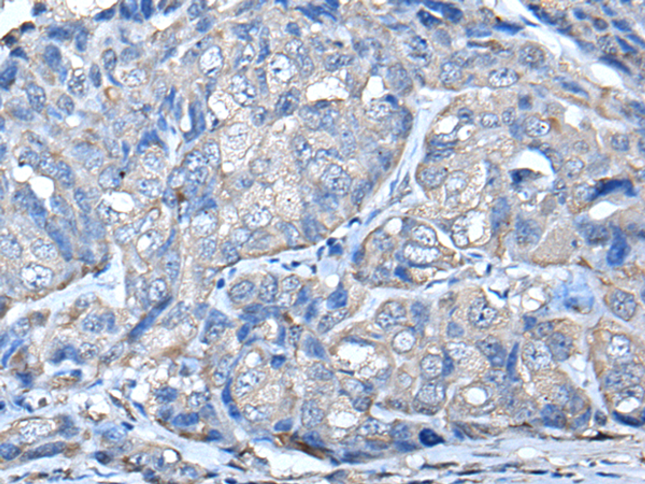 Immunohistochemistry of paraffin-embedded Human breast cancer tissue  using PRKAR2A Polyclonal Antibody at dilution of 1:50(×200)