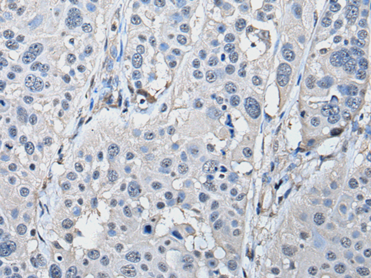 Immunohistochemistry of paraffin-embedded Human esophagus cancer tissue  using PRKAR2A Polyclonal Antibody at dilution of 1:50(×200)