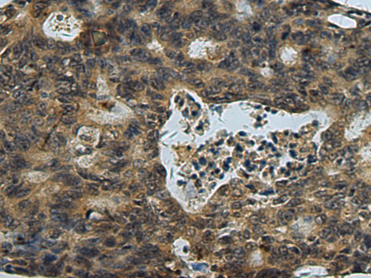 Immunohistochemistry of paraffin-embedded Human colorectal cancer tissue  using PLTP Polyclonal Antibody at dilution of 1:60(×200)