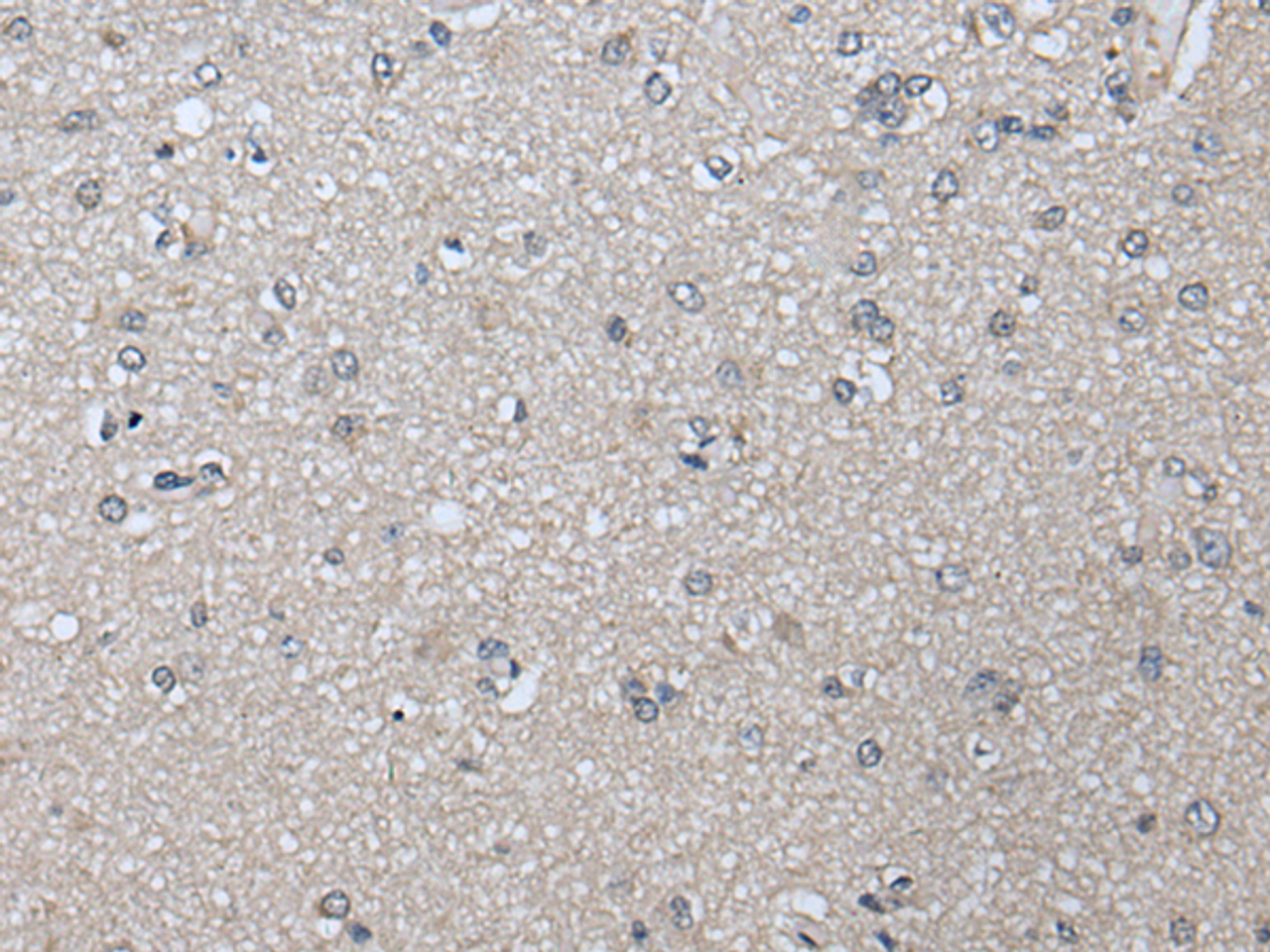 Immunohistochemistry of paraffin-embedded Human brain tissue  using PRAME Polyclonal Antibody at dilution of 1:65(×200)