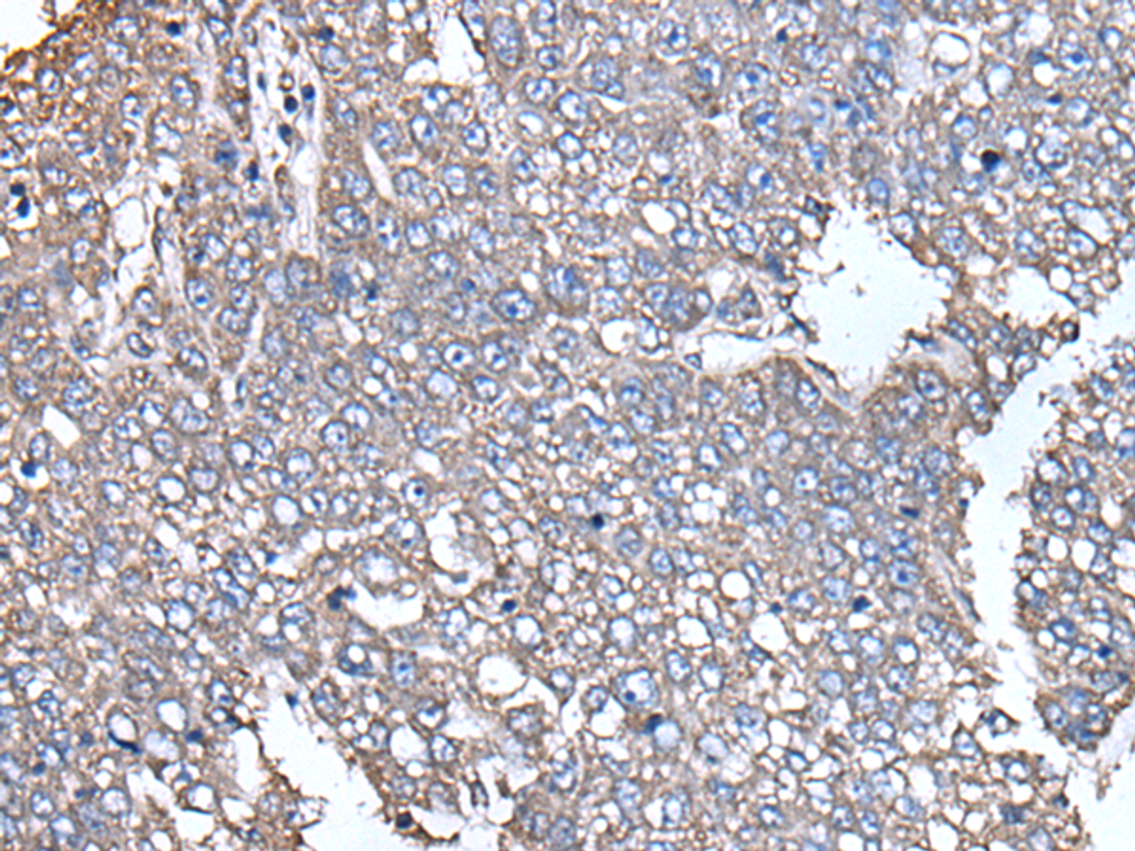 Immunohistochemistry of paraffin-embedded Human liver cancer tissue  using SCP2 Polyclonal Antibody at dilution of 1:35(×200)