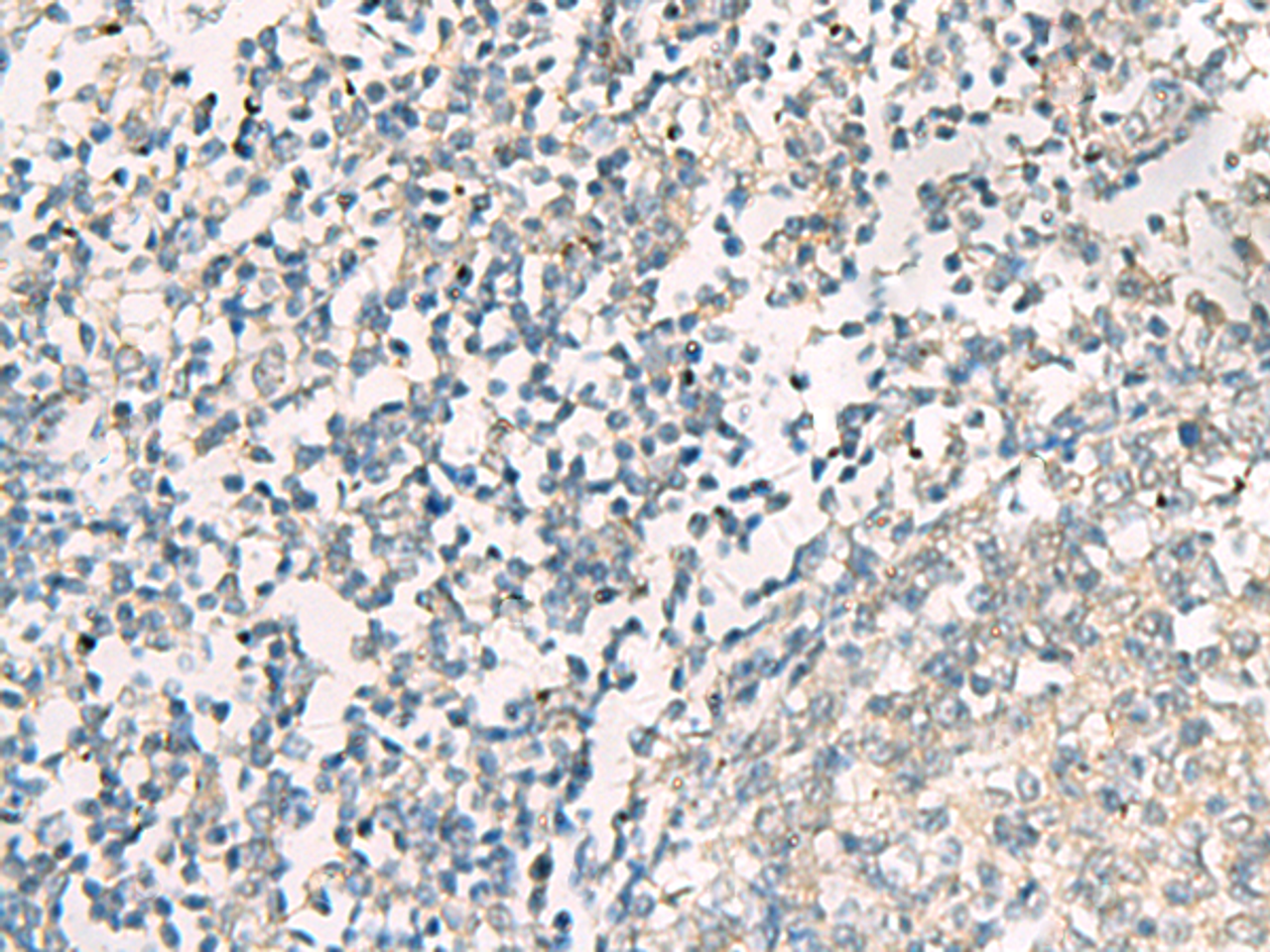 Immunohistochemistry of paraffin-embedded Human tonsil tissue  using SERPINB4 Polyclonal Antibody at dilution of 1:40(×200)