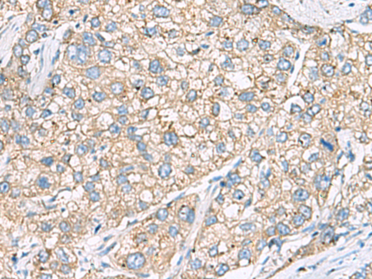 Immunohistochemistry of paraffin-embedded Human liver cancer tissue  using SHC3 Polyclonal Antibody at dilution of 1:40(×200)