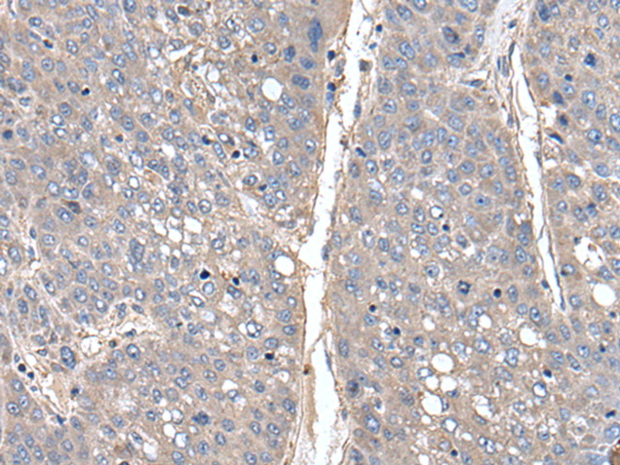 Immunohistochemistry of paraffin-embedded Human liver cancer tissue  using THAP10 Polyclonal Antibody at dilution of 1:40(×200)