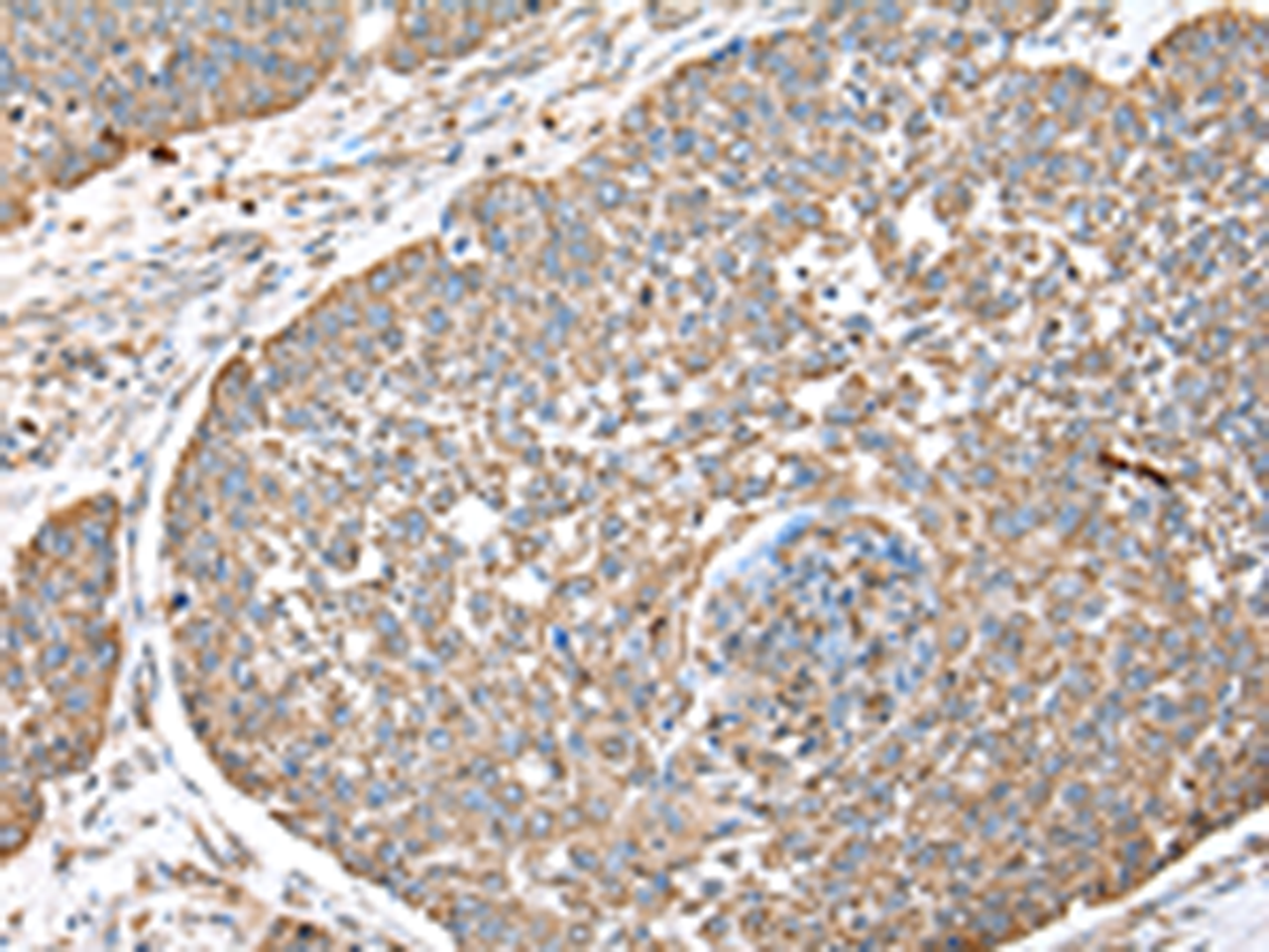 Immunohistochemistry of paraffin-embedded Human lung cancer tissue  using DPH7 Polyclonal Antibody at dilution of 1:40(×200)