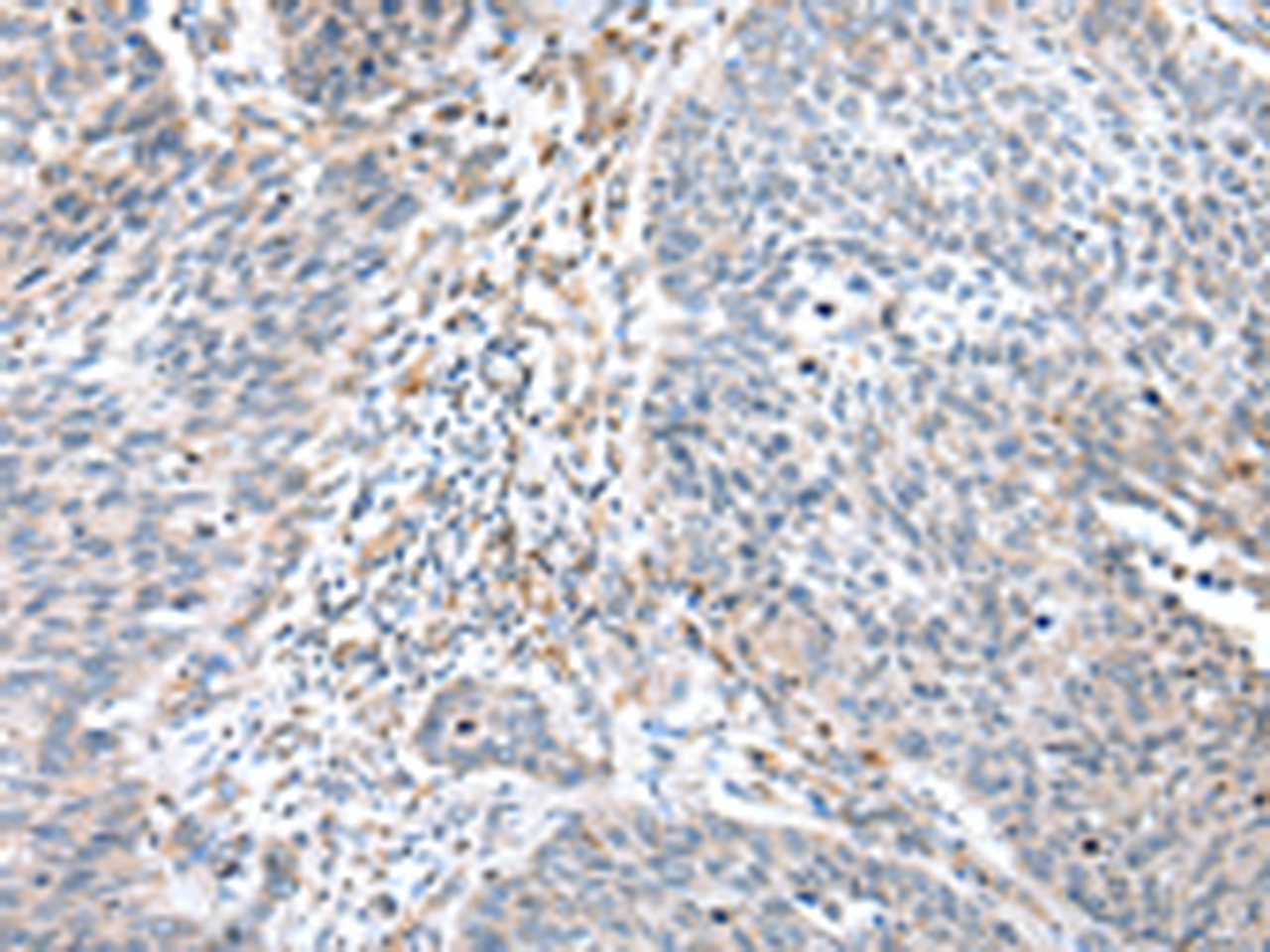 Immunohistochemistry of paraffin-embedded Human lung cancer tissue  using WFDC5 Polyclonal Antibody at dilution of 1:60(×200)