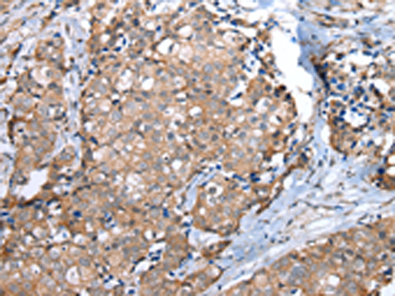 Immunohistochemistry of paraffin-embedded Human breast cancer tissue  using WFDC5 Polyclonal Antibody at dilution of 1:60(×200)
