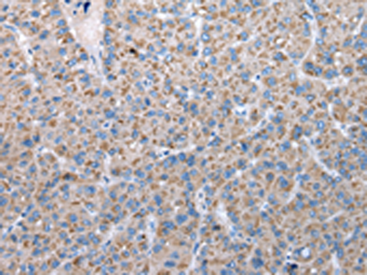 Immunohistochemistry of paraffin-embedded Human liver cancer tissue  using FKBPL Polyclonal Antibody at dilution of 1:50(×200)