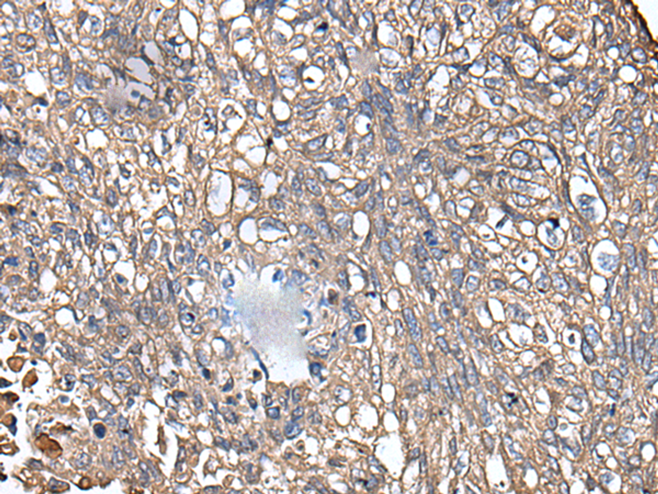Immunohistochemistry of paraffin-embedded Human lung cancer tissue  using KRT73 Polyclonal Antibody at dilution of 1:55(×200)