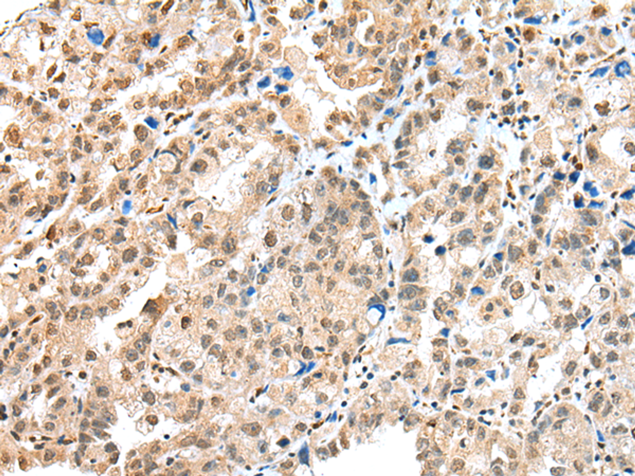 Immunohistochemistry of paraffin-embedded Human ovarian cancer tissue  using S100A16 Polyclonal Antibody at dilution of 1:25(×200)