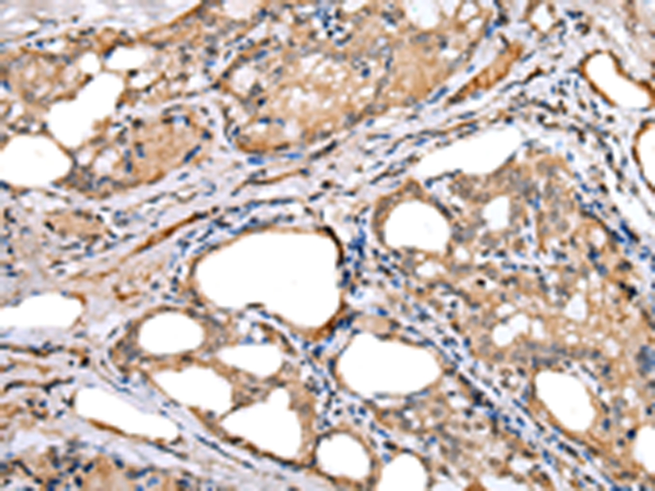 Immunohistochemistry of paraffin-embedded Human thyroid cancer tissue  using LRRC19 Polyclonal Antibody at dilution of 1:30(×200)