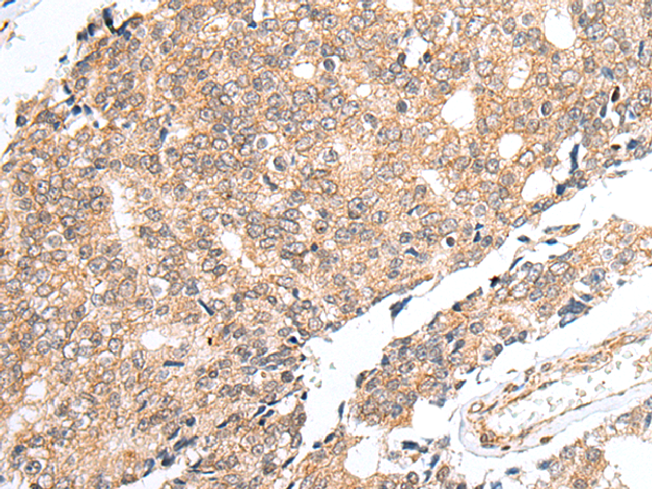 Immunohistochemistry of paraffin-embedded Human prost at e cancer tissue  using PRELID1 Polyclonal Antibody at dilution of 1:40(×200)