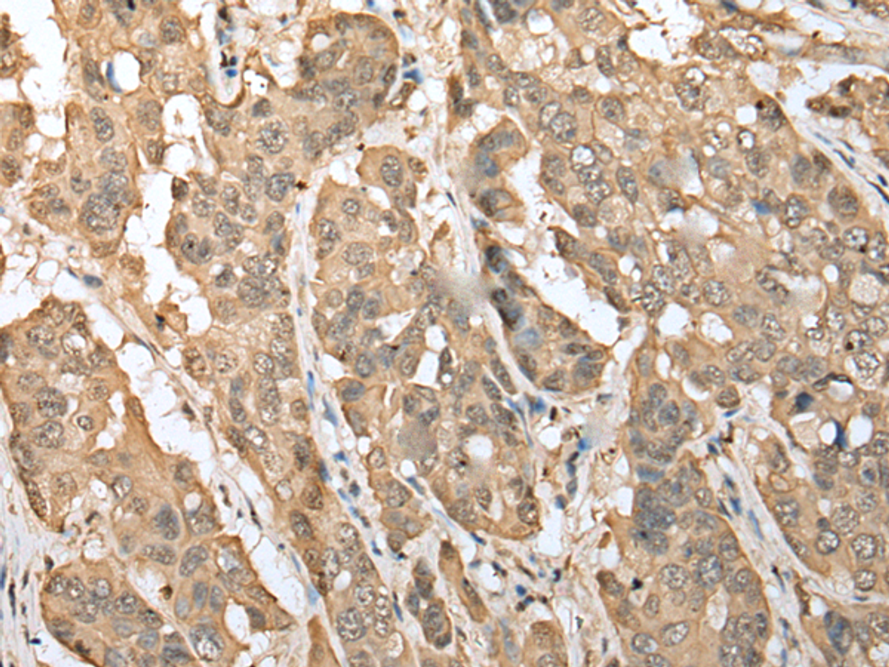 Immunohistochemistry of paraffin-embedded Human breast cancer tissue  using ZNF672 Polyclonal Antibody at dilution of 1:30(×200)