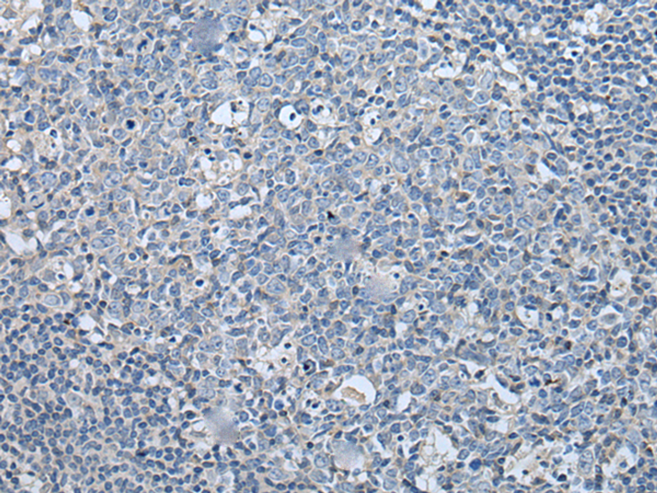 Immunohistochemistry of paraffin-embedded Human tonsil tissue  using LASP1 Polyclonal Antibody at dilution of 1:35(×200)