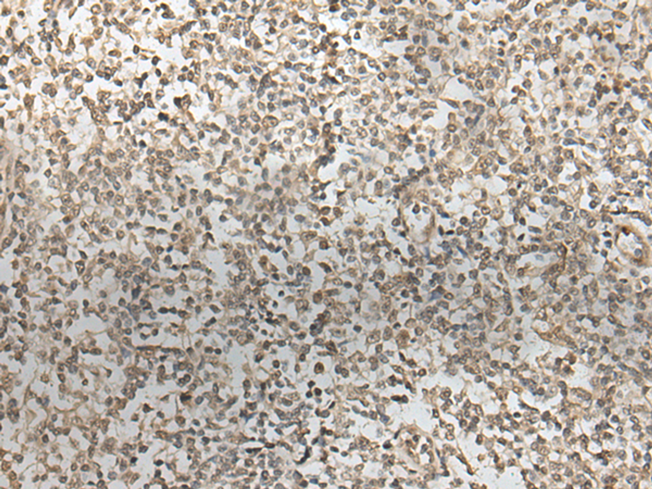 Immunohistochemistry of paraffin-embedded Human tonsil tissue  using ZNF274 Polyclonal Antibody at dilution of 1:35(×200)