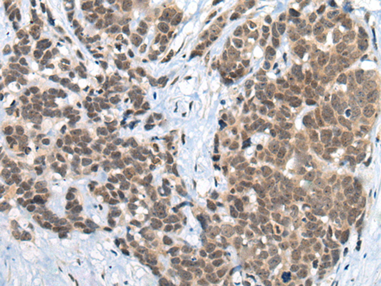 Immunohistochemistry of paraffin-embedded Human thyroid cancer tissue  using ZNF83 Polyclonal Antibody at dilution of 1:50(×200)