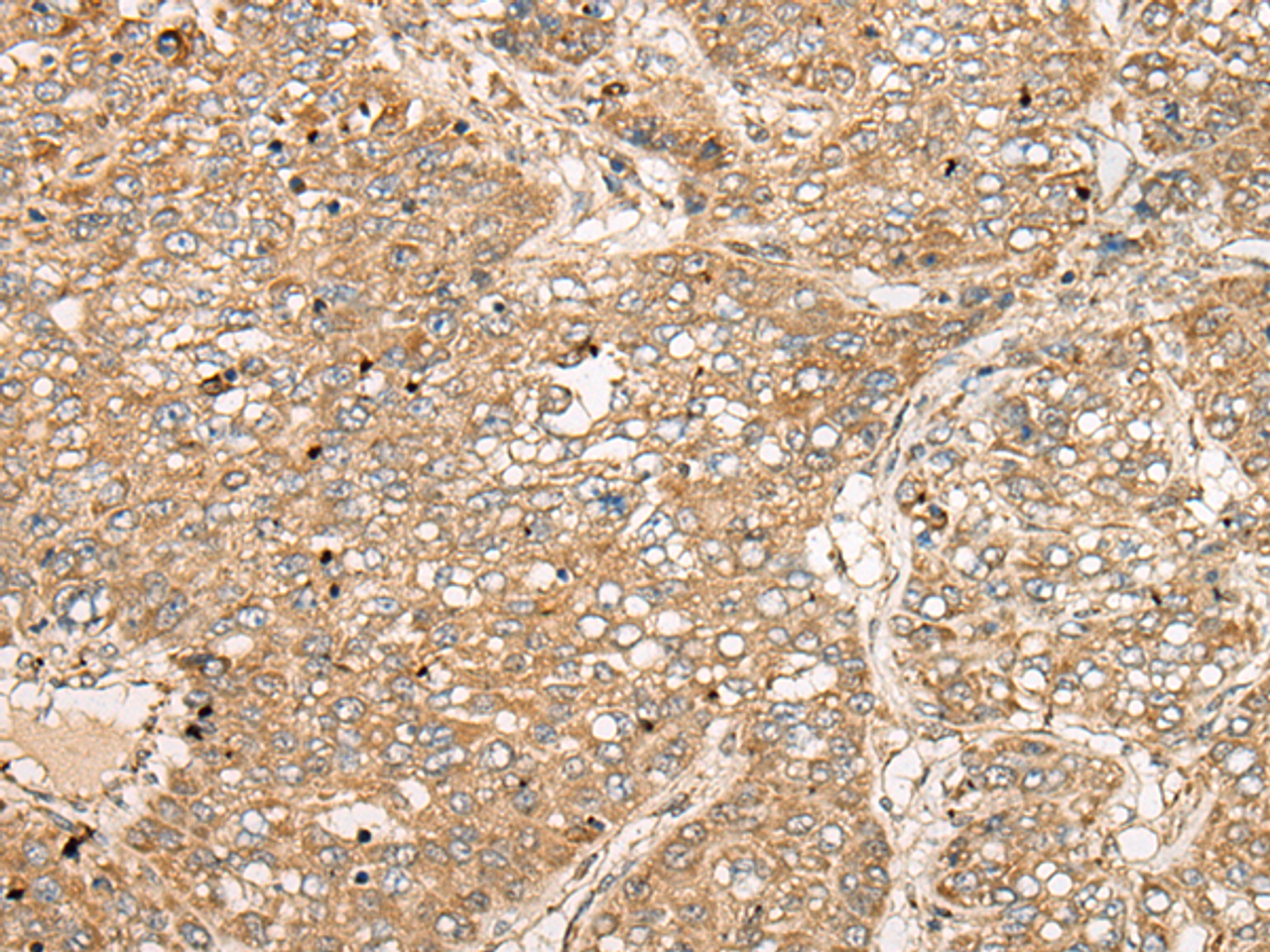 Immunohistochemistry of paraffin-embedded Human liver cancer tissue  using TDGF1 Polyclonal Antibody at dilution of 1:50(×200)