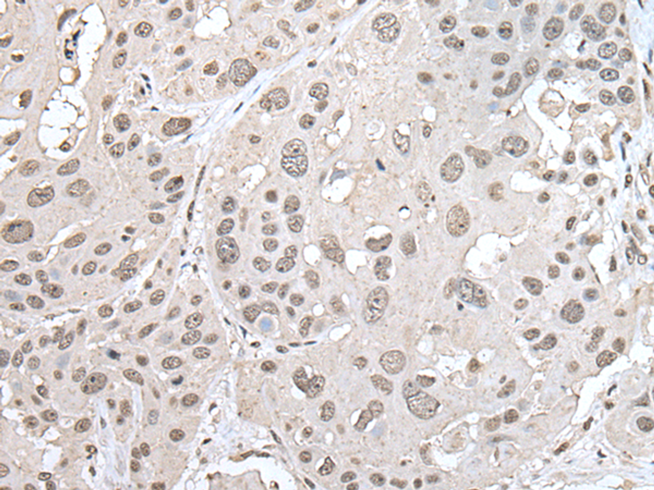 Immunohistochemistry of paraffin-embedded Human esophagus cancer tissue  using VRK1 Polyclonal Antibody at dilution of 1:30(×200)