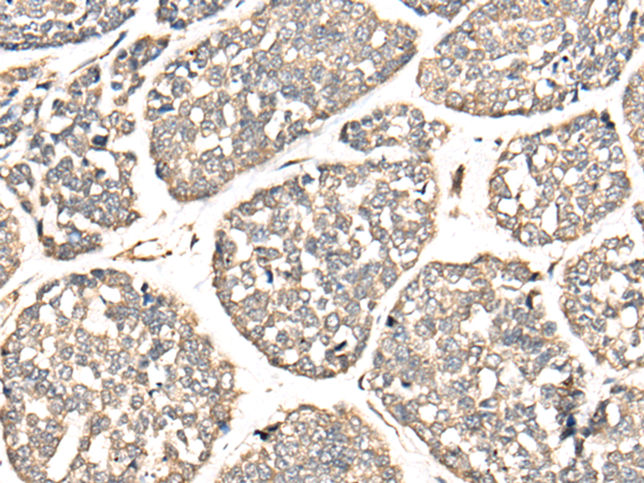 Immunohistochemistry of paraffin-embedded Human esophagus cancer tissue  using VTI1B Polyclonal Antibody at dilution of 1:30(×200)