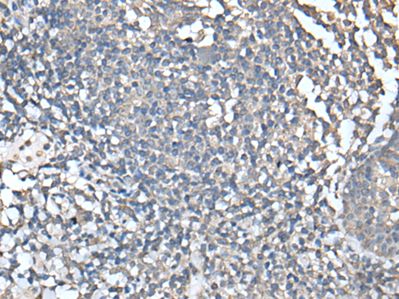 Immunohistochemistry of paraffin-embedded Human tonsil tissue  using UBASH3A Polyclonal Antibody at dilution of 1:50(×200)