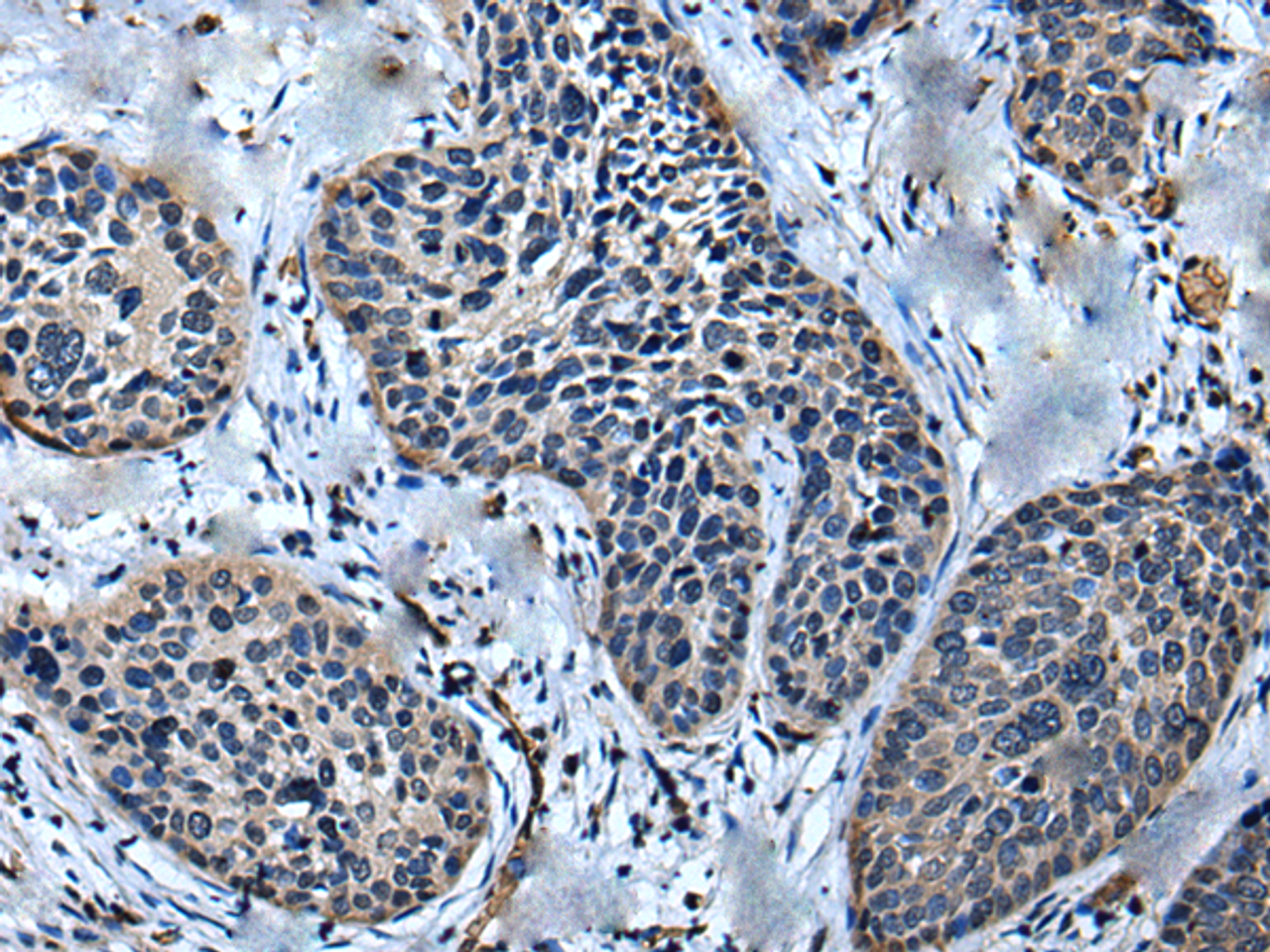 Immunohistochemistry of paraffin-embedded Human cervical cancer tissue  using ULK4 Polyclonal Antibody at dilution of 1:75(×200)