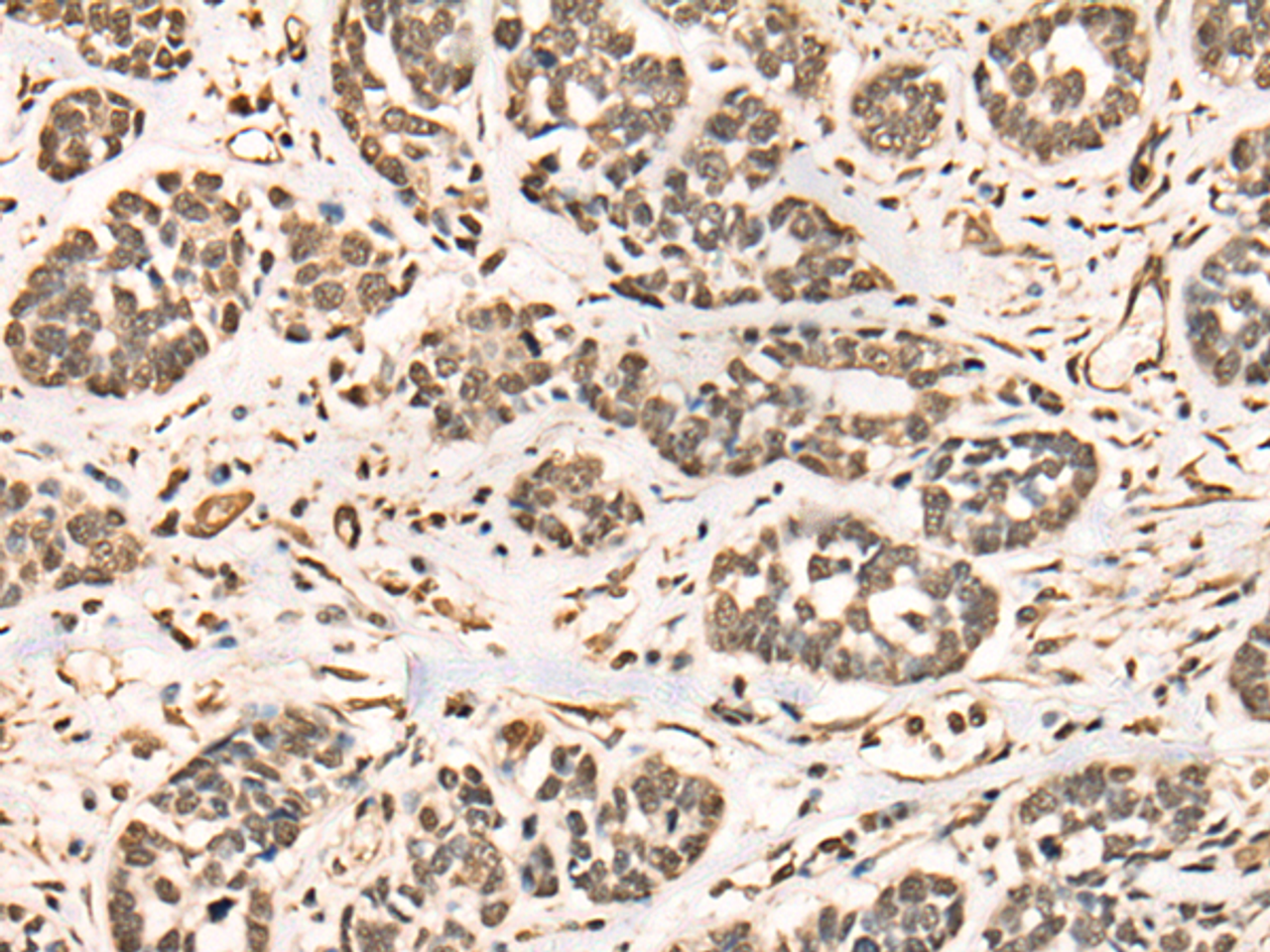 Immunohistochemistry of paraffin-embedded Human esophagus cancer tissue  using BRD7 Polyclonal Antibody at dilution of 1:50(×200)