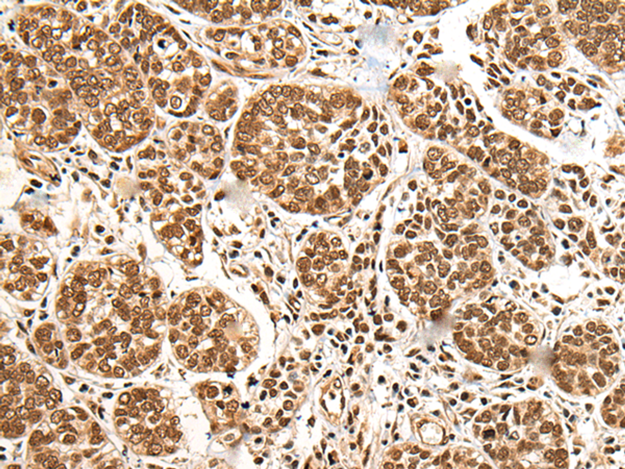 Immunohistochemistry of paraffin-embedded Human esophagus cancer tissue  using BRSK1 Polyclonal Antibody at dilution of 1:95(×200)