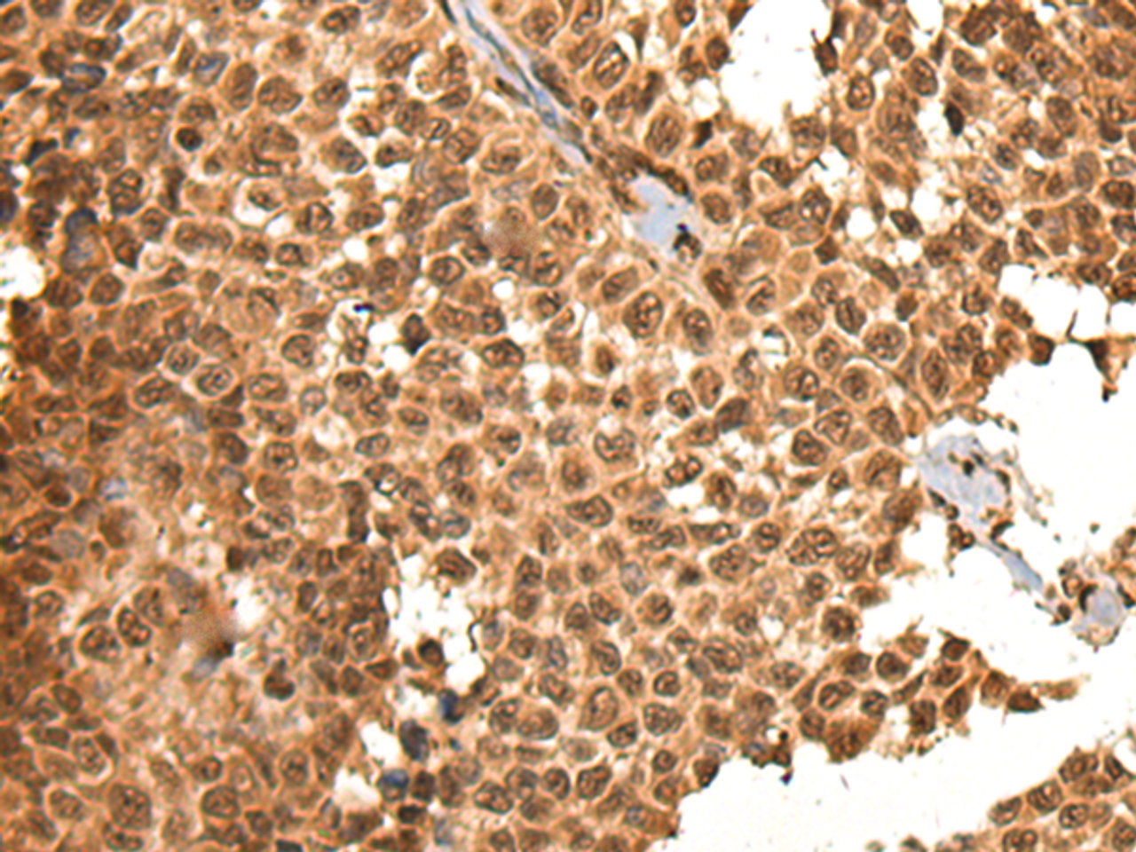 Immunohistochemistry of paraffin-embedded Human ovarian cancer tissue  using BRSK1 Polyclonal Antibody at dilution of 1:95(×200)
